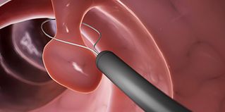 Endoscopy Consumables